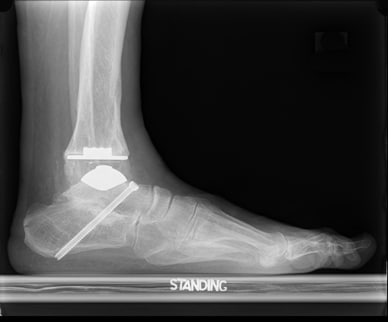Lateral radiograph after implantation